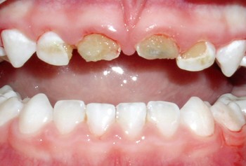 اهمیت دندان های شیری