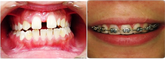 شکاف بین دندانی (دیاستم دندانی)