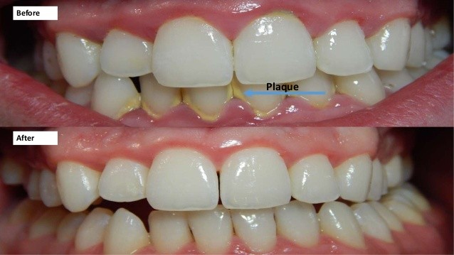 پلاک دندانی