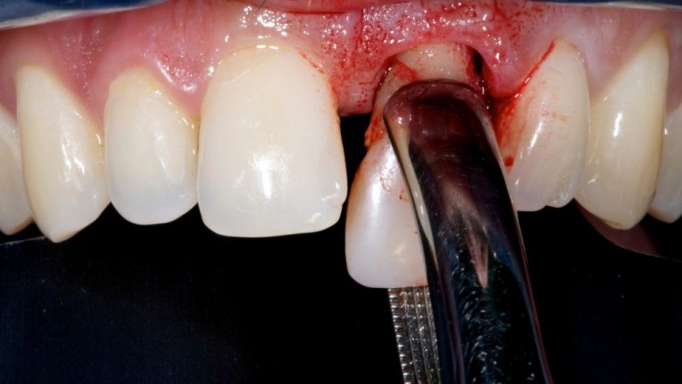 اقدامات لازم پس از کشیدن و جراحی دندان