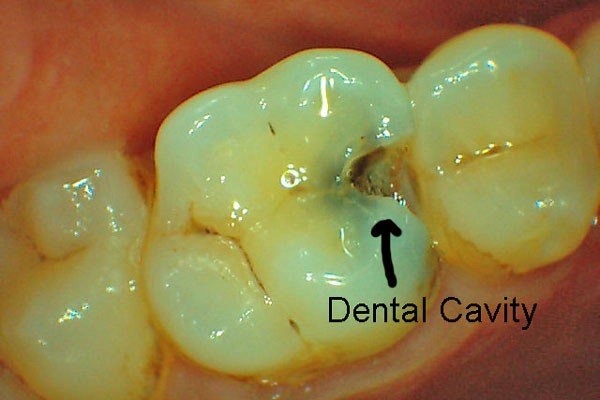 پوسیدگی های دندانی