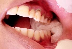 اقدامات لازم پس از کشیدن و جراحی دندان