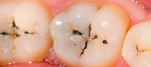 پوسیدگی های دندانی