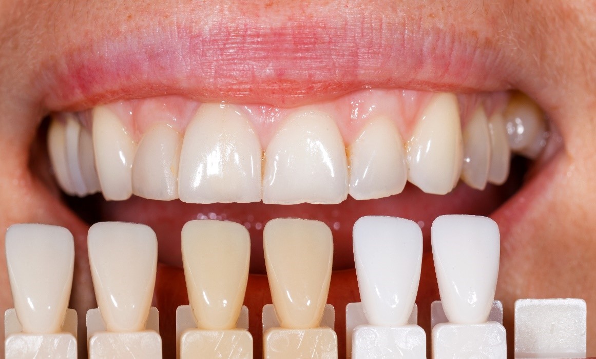 فواید و کاربردهای ونیر دندان (لمینت)
