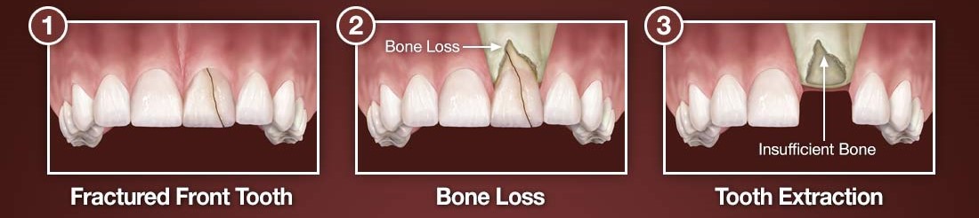 پیوند استخوان پیش از کاشت ایمپلنت دندان