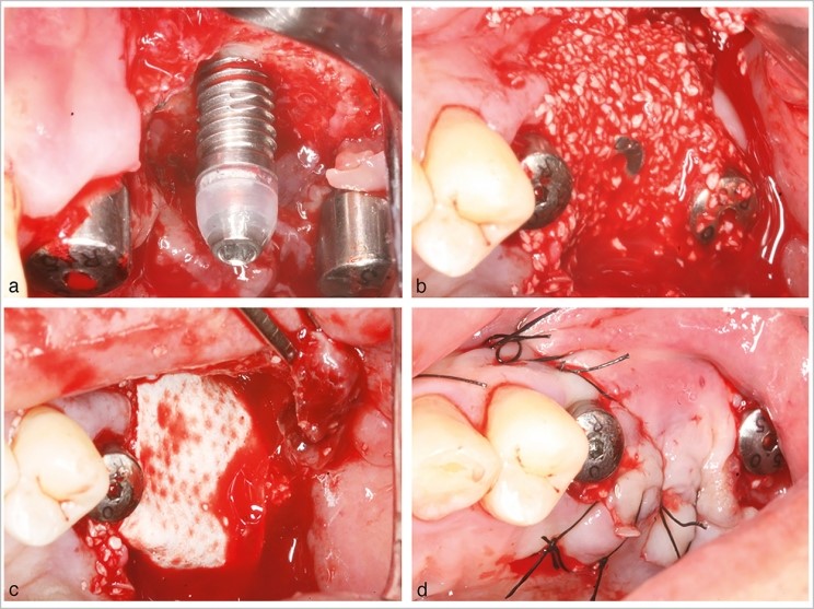 بیماری های شایع پس از کاشت ایمپلنت دندان