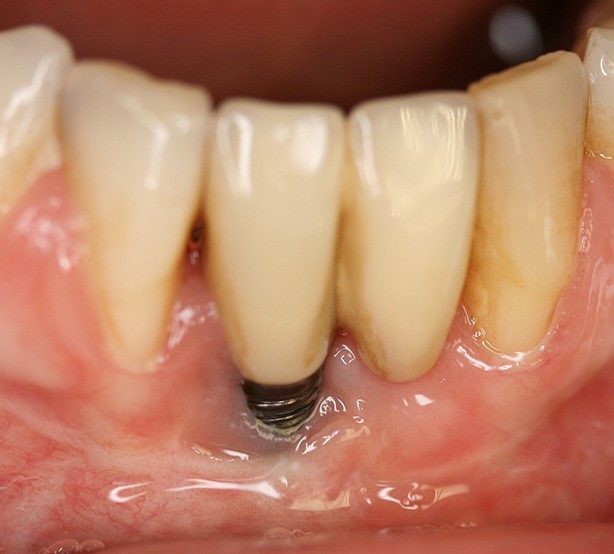 انواع عفونت ایمپلنت های دندانی