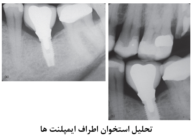 تصاویر رادیوگرافی در کاشت ایمپلنت های دندانی