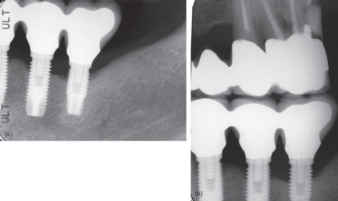 تصاویر رادیوگرافی در کاشت ایمپلنت های دندانی