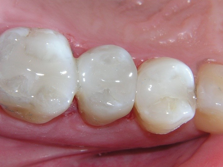 هزینه پر کردن دندان در کرج