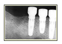 بریج های دندانی بر پایه ایمپلنت