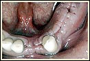 بریج های دندانی بر پایه ایمپلنت