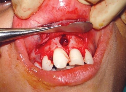 هایپردنشیا یا دندان اضافی