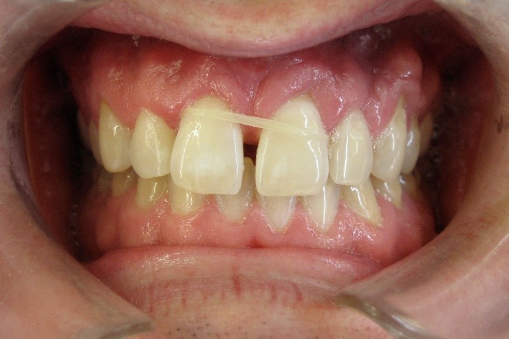 فرنوم و فرنکتومی در دندانپزشکی