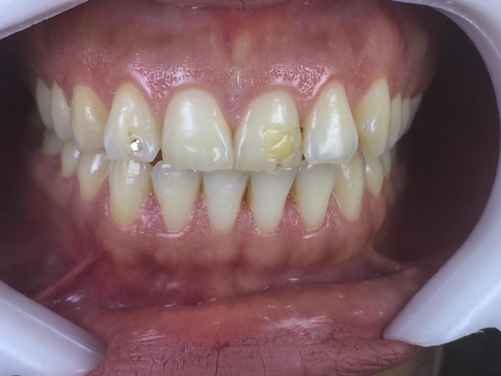 بلیچینک و ترمیم زیبایی دندان قدامی