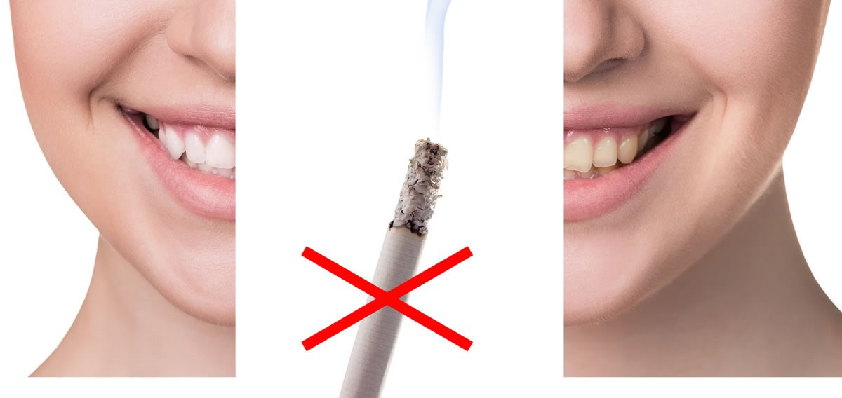 تاثیر سیگار بر دهان و دندان