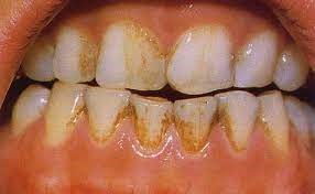 درمان لکه های دندان