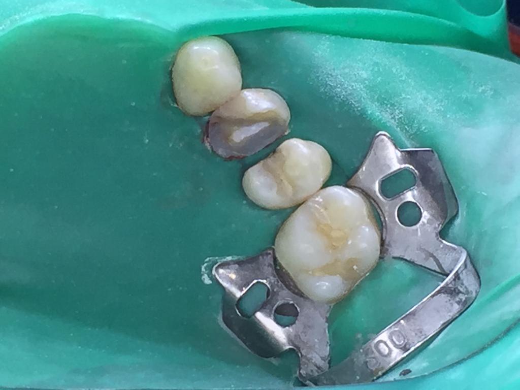 بازسازي دندان شكسته شده به روش انله كامپوزيتي بعد از DME