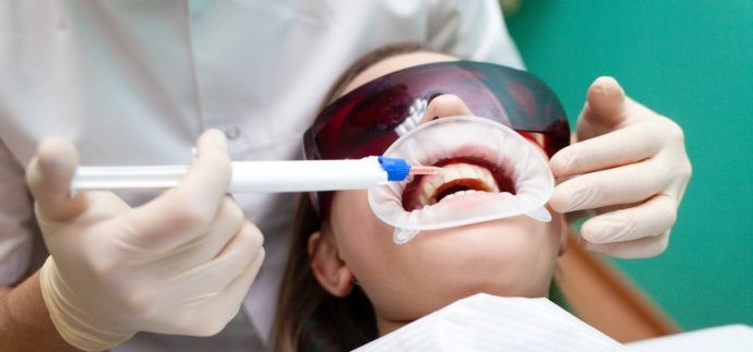 درمان لکه های دندان