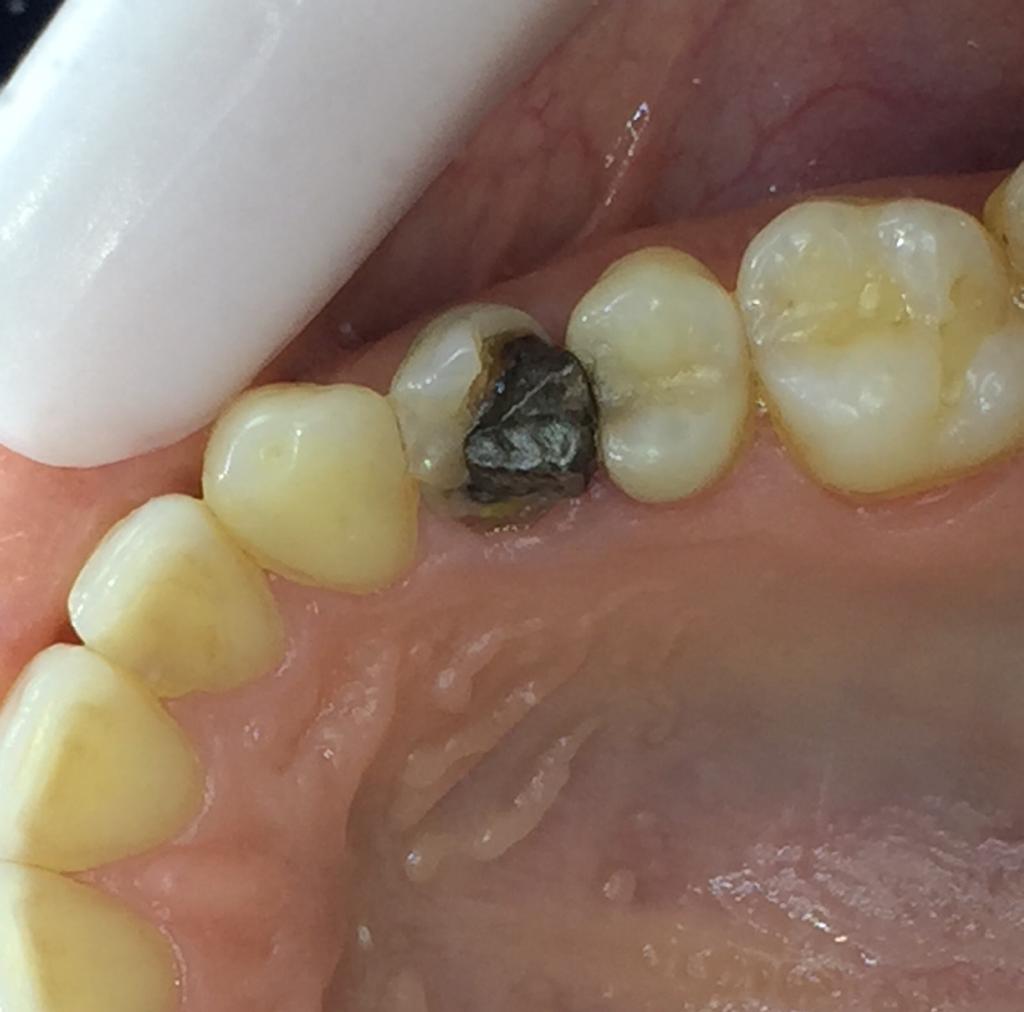 بازسازی دندان شکسته شده به روش انله کامپوزیتی بعد از DME
