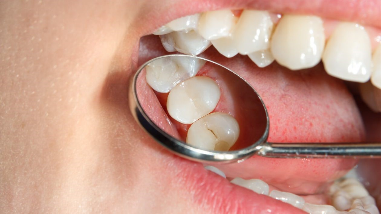 حساسیت پس از پر کردن دندان