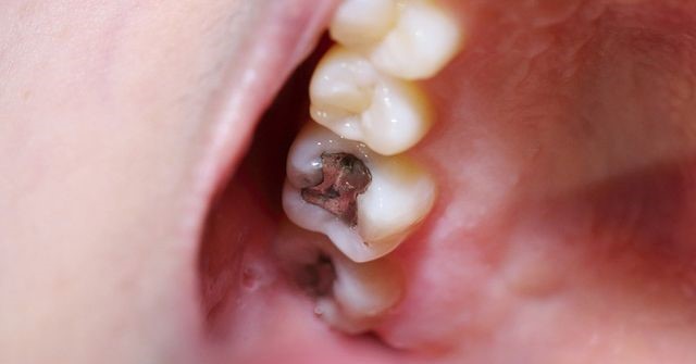 حساسیت پس از پر کردن دندان