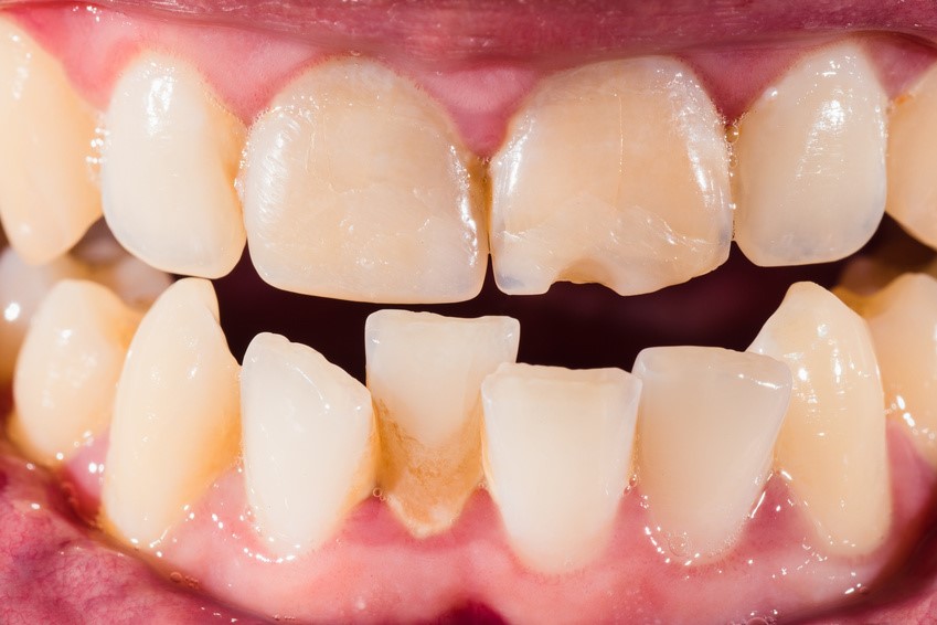 کجی دندان
