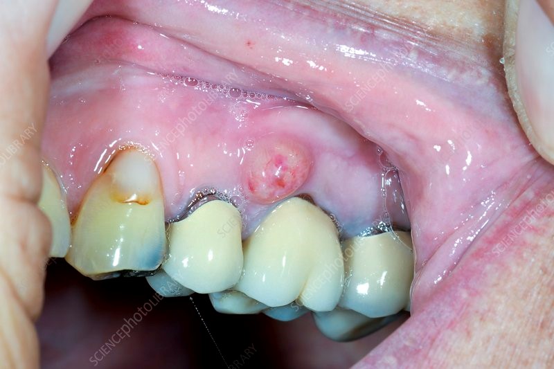 عفونت سینوس با منشا دندانی