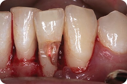 تحلیل دندان