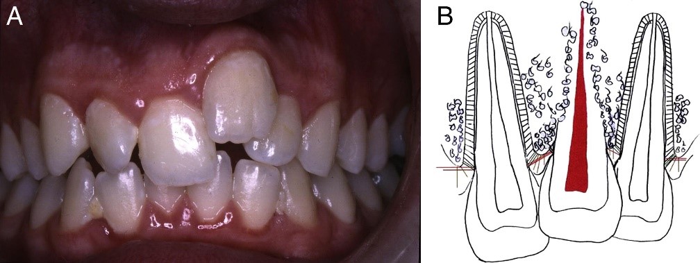 انکیلوز دندان یا دندان فک جوش