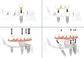 ایمپلنت دندانی یک روزه یا فوری