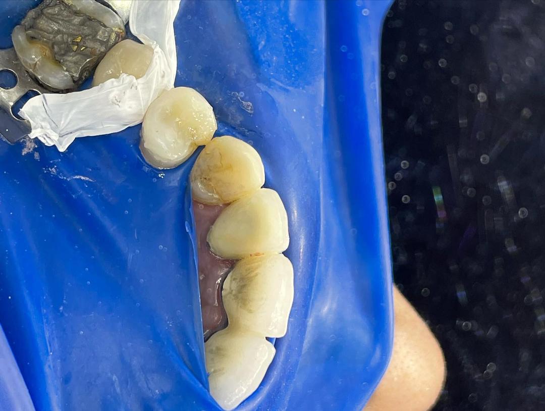 بازسازی تاج دندان