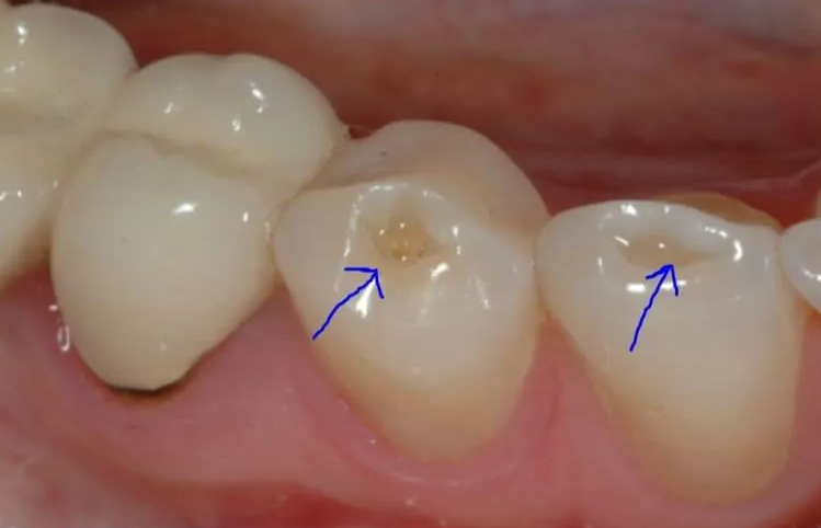 حساسیت دندان پس از جرمگیری