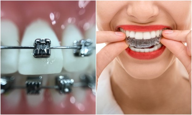 سفید کردن دندان در ارتودنسی 