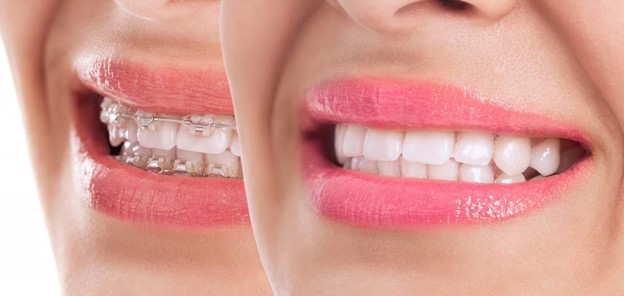 سفید کردن دندان در ارتودنسی 