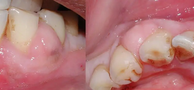آنتی بیوتیک دندانی برای آبسه دندان
