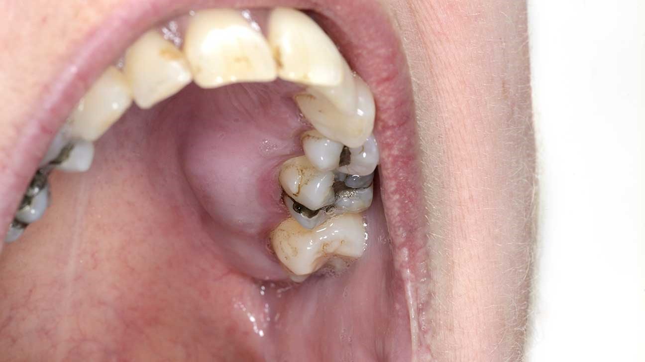 آنتی بیوتیک دندانی برای آبسه دندان