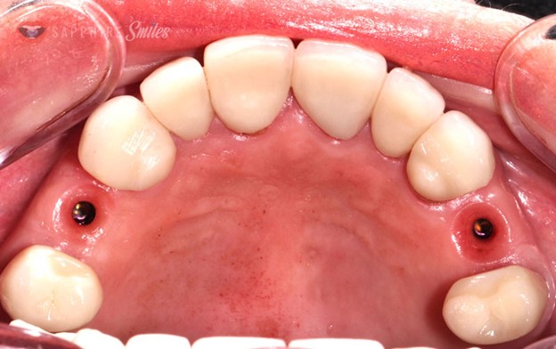 خارج کردن  ایمپلنت دندانی
