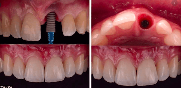 خارج کردن  ایمپلنت دندانی