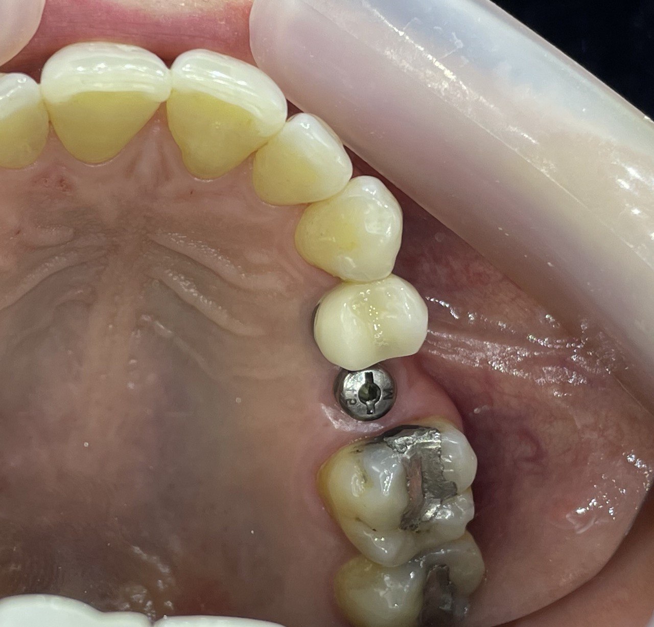 یک واحد ایمپلنت دندان