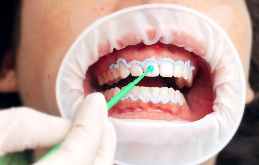 هیدروژن پراکسید و سفید کردن دندان‌ها