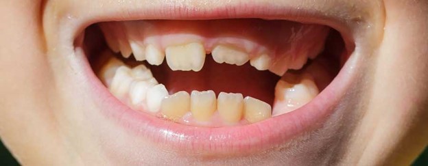 اثر پستانک روی دندان کودکان