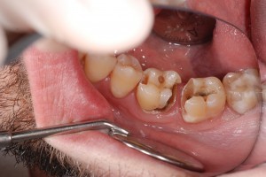 بوی بد دهان ناشی از پوسیدگی دندان