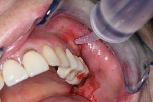 چه زمانی باید به دنبال مراقبت های اورژانسی دندانپزشکی باشیم؟