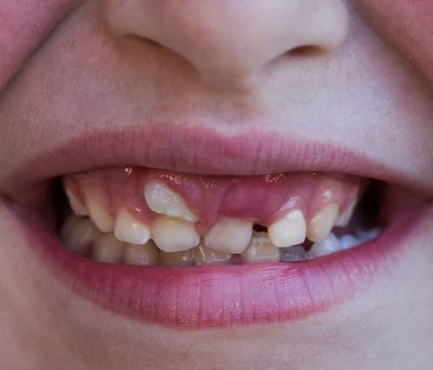 نقش سن در رشد دندان