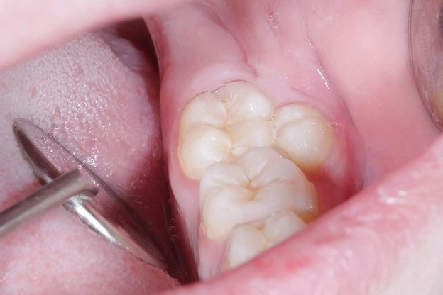 عوامل مؤثر بر رشد دندان
