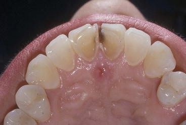 چگونه از دندان های خود در برابر آسیب رفلاکس اسید محافظت کنیم؟