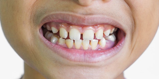 کدام نوع فاصله بین دندان ها بدون بریس قابل اصلاح نیست؟